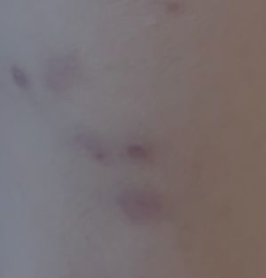 Cantharidin or beetle-juice use for molluscum-mollenol