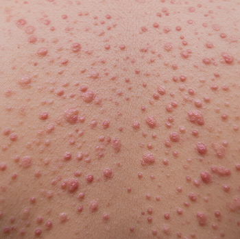 chicken pox