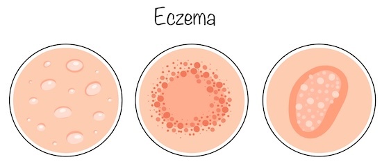 The morphology and type stages of eczema