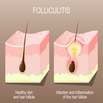Mollenol for follculitis