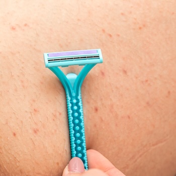 Folliculitis from shaving known as shaving rash.