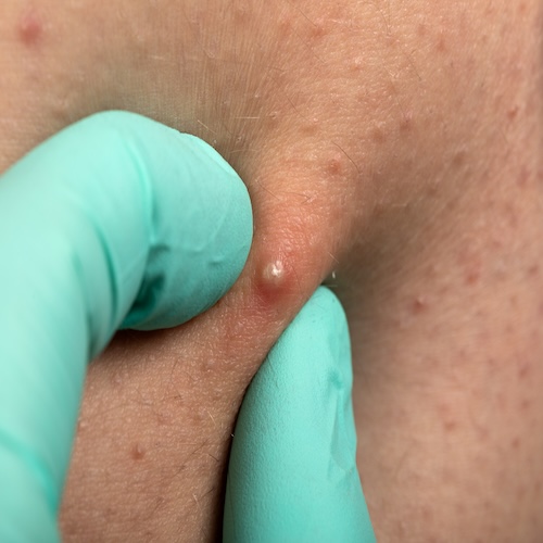 Use Mollenol for folliculitis