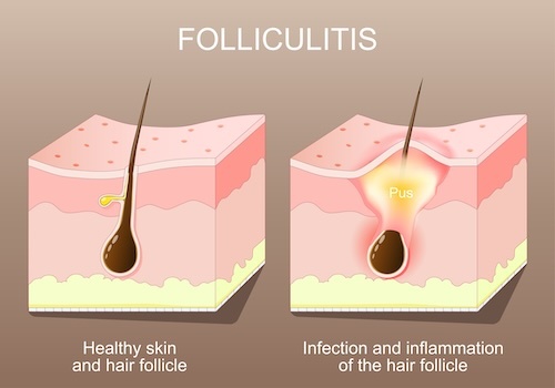 How folliculitis infects the skin.