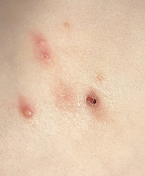 How to get rid of molluscum? Use Mollenol over the counter treatment at home.