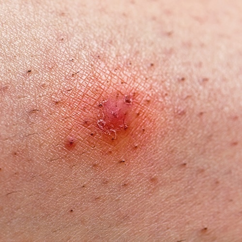 Mollenol for in grown hairs Use Mollenol for an ingrown hair