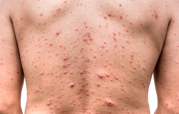 Mollenol for acne and pimples.