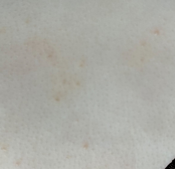 Beginning stage tiny molluscum bumps. Use Mollenol