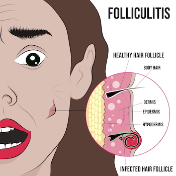 Mollenol can be used for folliculitis and infect hair follicles. 