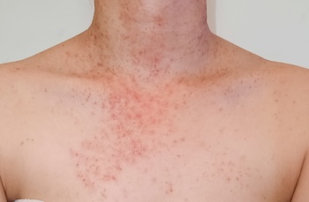 Using Mollenol for folliculitis, adult pimples and infected hair follicles. 
