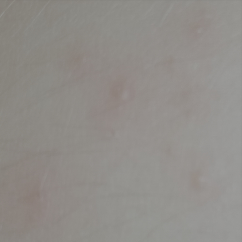 Mollenol for molluscum and folliculitis