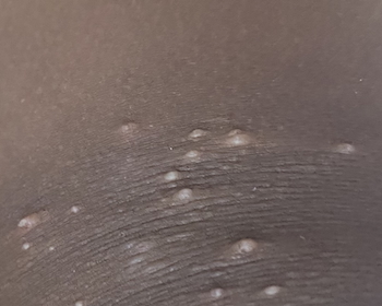 Molluscum infection, black skin