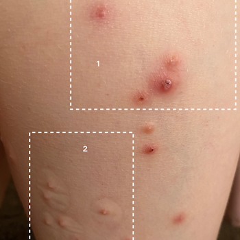 Molluscum spreading across the leg of a child. 