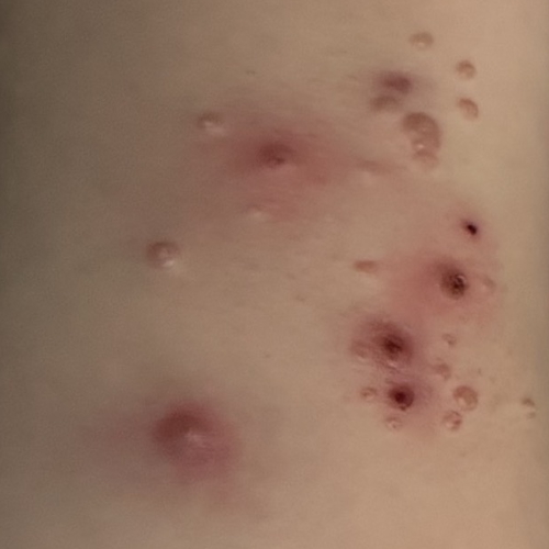 Molluscum infected with bacterial infection is a too common problem.