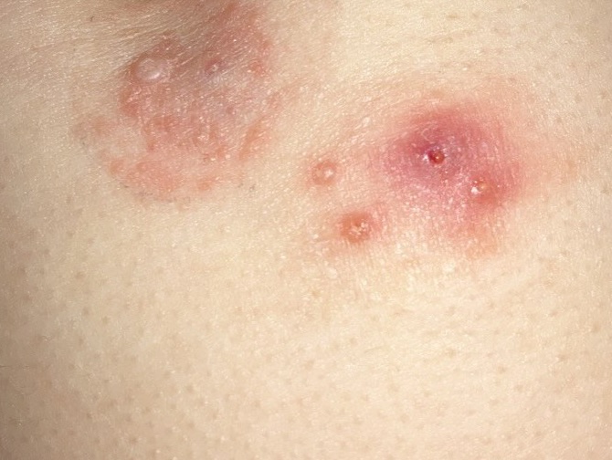 What is molluscum contagiosum? The growth and healing stages of molluscum. 