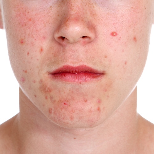Using Mollenol for pimples.