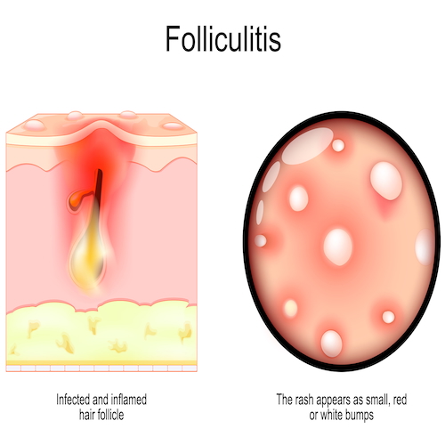 Poor skin barrier allows folliculitis to flourish