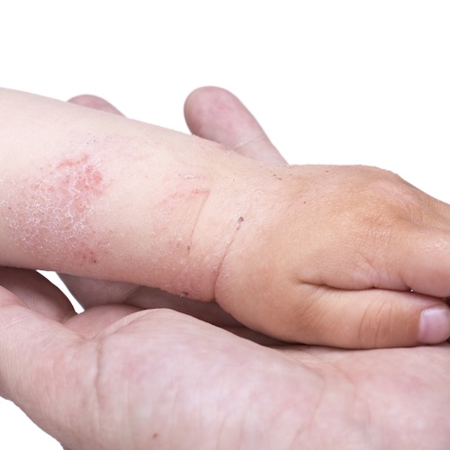 Mollenol for better skin