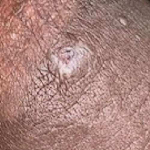 Molluscum on black skin.