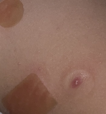 Mollenol Patches on the skin of a child with molluscum infection. Using Mollenol hydrocolloid patches for molluscum.
