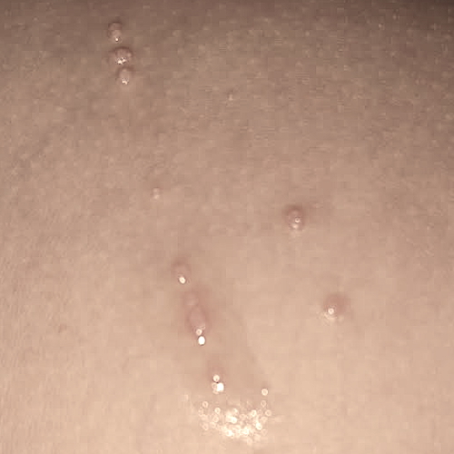 Are molluscum itchy. 