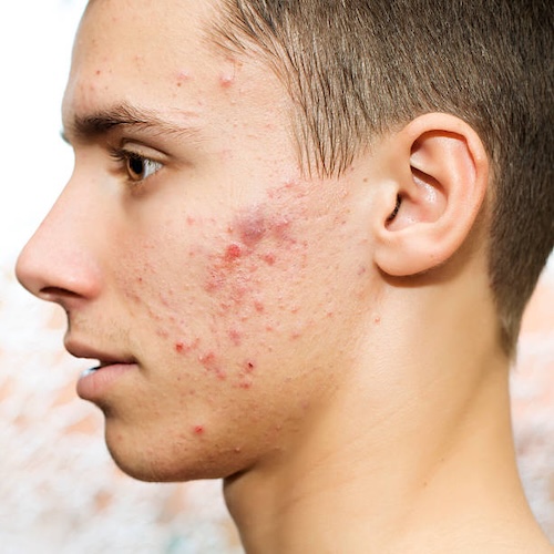 Pimples and acne on a young man's face.