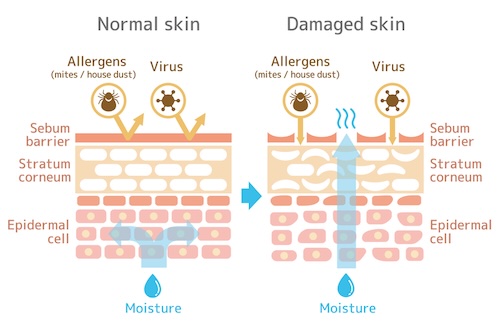 Molluscum and bacteria enter the skin through damaged skin barrier. 