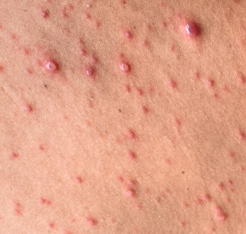 Mollenol can be used for pimples and acne.