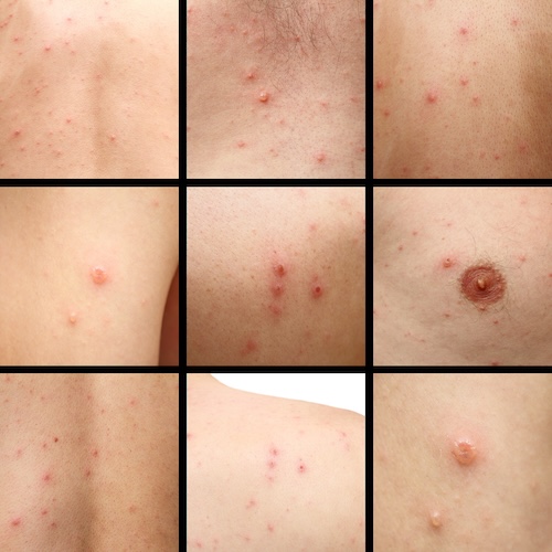 The many different types of pimples and acne. Use Mollenol.